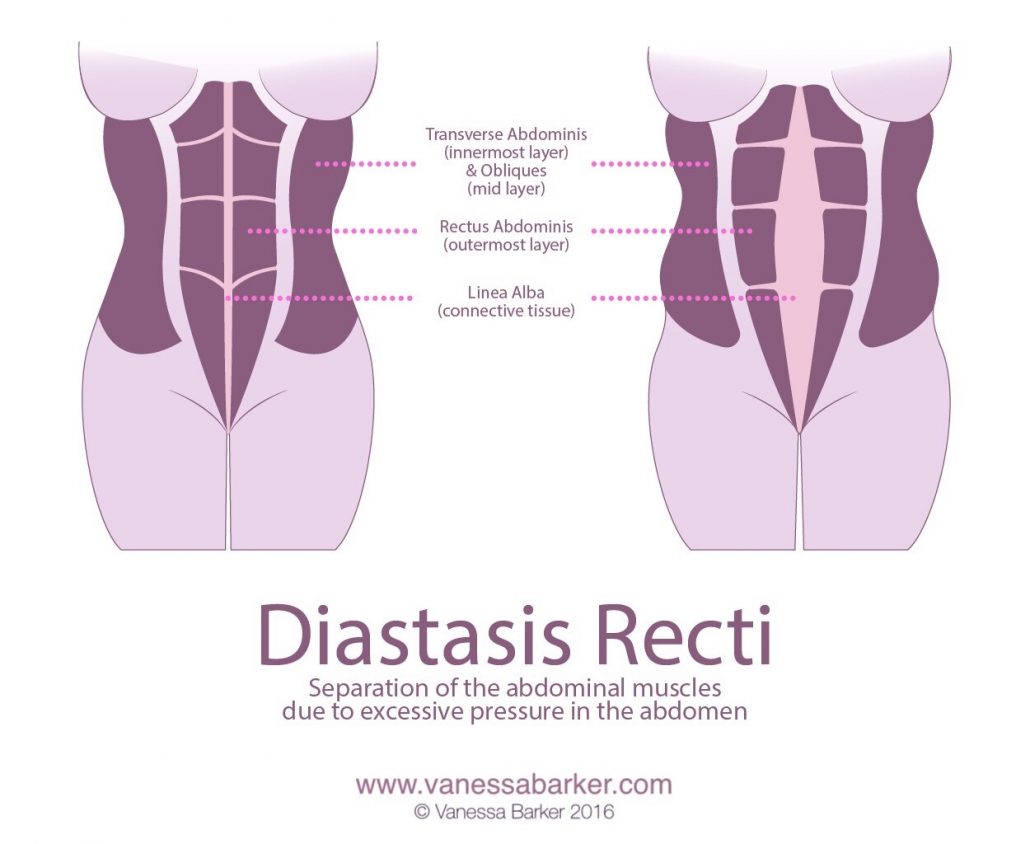 Do You Have Diastasis Recti Vanessa Barker Fitness