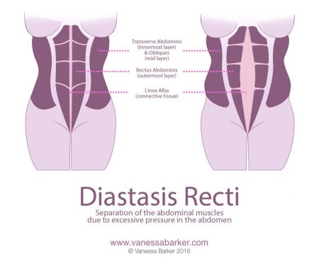 Do You Have Diastasis Recti? - Vanessa Barker Fitness