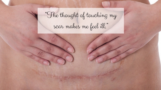 Getting Over The Fear Of My C-section Scar 